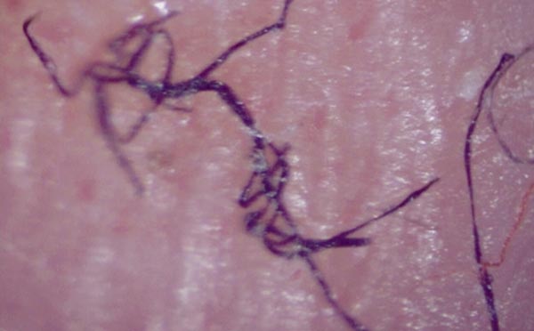 Morgellons Disease